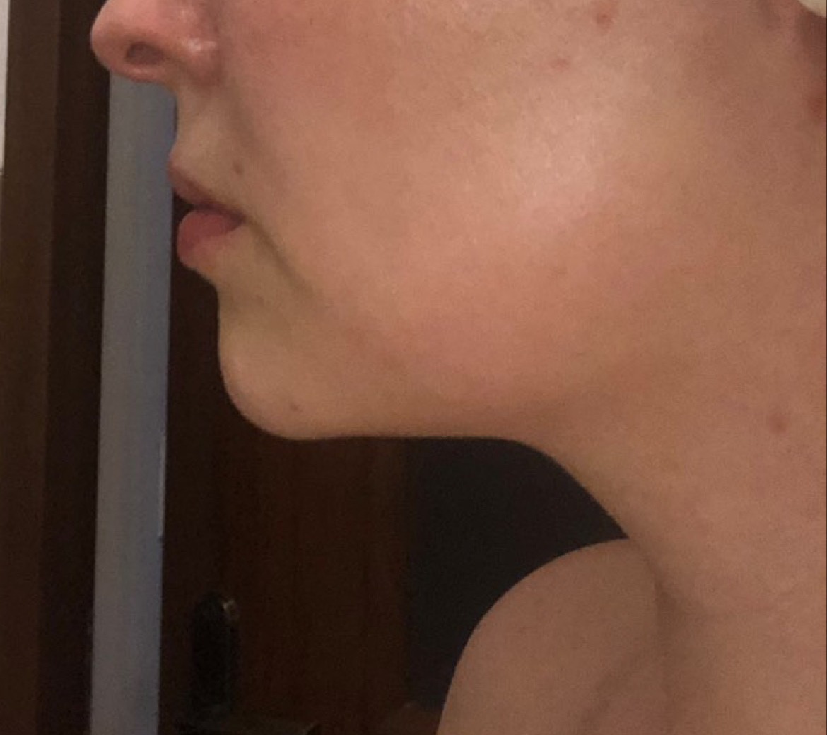 Po — profil — linia żuchwy